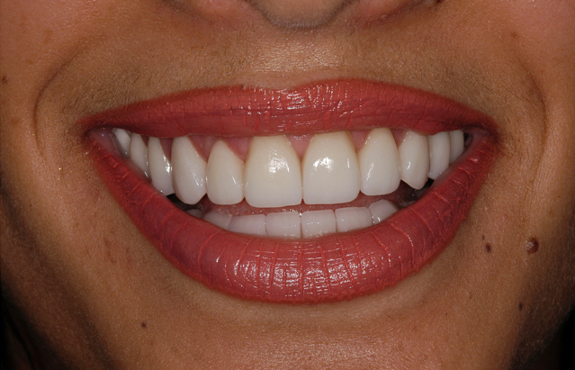 South Miami Veneers | Veneers in South Miami | Coral Gables Veneers